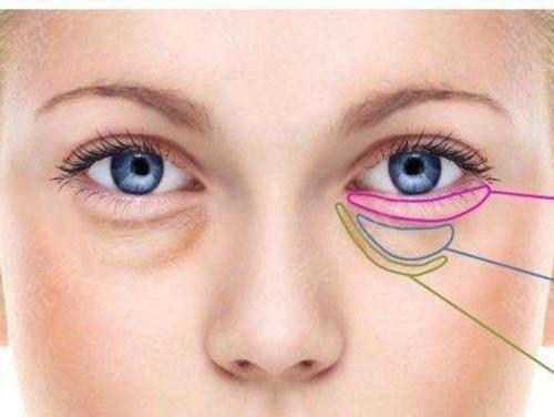 外切眼袋的過程是什么樣子的？