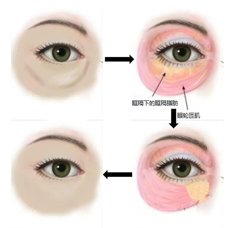 消除眼袋的方法有哪些？