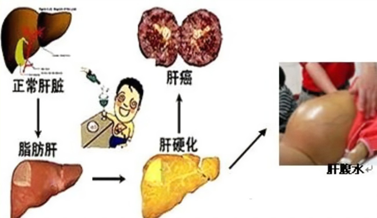 查出肝硬化還有救嗎？