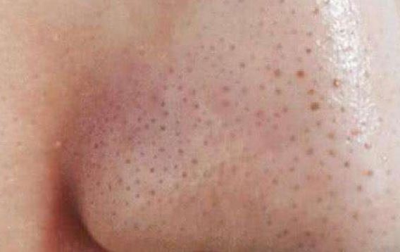 清潔面膜哪個(gè)牌子可以快速祛黑頭？趙薇、薇婭 推薦的紐西之謎泥膜真的好用嗎？